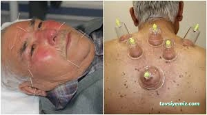 Uzm. Dr. Özgür Sinan Cengiz, Akupunktur