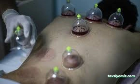 Yenimahalle Hacamat Tedavisi