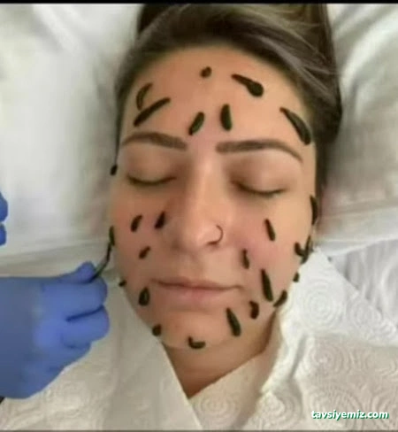 Yüksekova Hacamat Ve Sülük Tedavisi