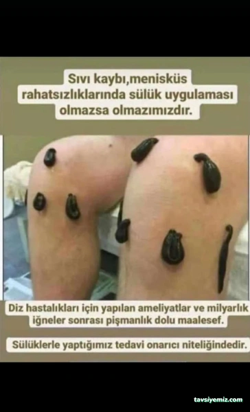 Yüksekova Hacamat Ve Sülük Tedavisi