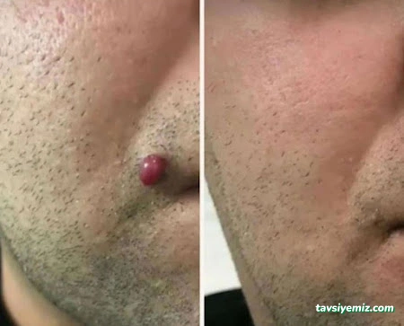 Yüksekova Hacamat Ve Sülük Tedavisi